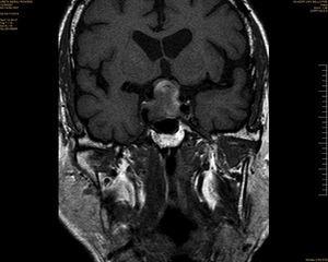 Gadolinium-enhanced T1-weighted spin echo (SE) MRI in the coronal plane.