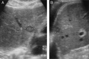 (A and B) Ultrasound shows examples of tumor recurrence due to hepatic metastases.