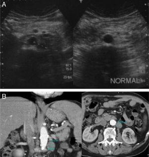 (A) Retroperitoneal US examinations of 2 patients show one patient with a pathological mass corresponding to an adenopathy of tumor recurrence, and the other patient with no adenopathy. (B) Axial and coronal abdominal CT scan of a patient with recurrence shows retroperitoneal adenopathy.