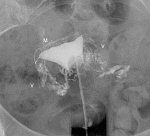 Hysterosalpingography. Left salpingectomy and right Essure in incorrect position (tube perforation) but without contrast passage to the tube. The contrast fills up the uterine cavity. Lineal fundus images indicating the passing of contrast to vessels of the myometrium (M) and parauterine serpiginose images, pelvic veins (V).