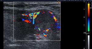 Thyroid ultrasound with color Doppler, transversal cut. One thyroid nodule with vascular pattern type II and peripheral vessels (arrow) in the context of thyroid nodular hyperplasia can be seen.