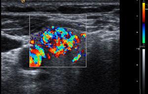 Thyroid ultrasound with color Doppler, transversal cut. One thyroid nodule with vascular pattern type III with increased central vascularization (arrow) in a thyroid nodule diagnosed of papillary carcinoma can be seen.