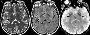 Multisystemic atrophy in its Parkinsonian variant. (A and B) Bilateral symmetric putamen atrophy with linear hyperintensity on T2 FSE (A) and T2 FLAIR (B) in the dorsal–lateral region of lenticular nuclei due to gliosis. (C) Axial sequence of magnetic susceptibility showing signal hypointensity in the posterior-lateral region of lenticular nucleus.