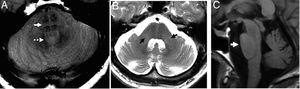 Multisystemic atrophy in its cerebellous variant. (A) Axial PD image showing “hot cross bun” sign (arrow) and dilation of the fourth ventricle (dotted arrow). (B) Axial FSE T2 image. Atrophy and hypersignal of the middle cerebellar peduncles (arrows) and dilation of the fourth ventricle. (C) Saggital T1 FLAIR image. Flattened ventral region due to atrophy-induced protuberance.