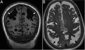 Corticobasal degeneration. (A) Coronal T1-weighted 3D image showing disproportionate atrophy of parietal gyri (arrows). (B) Axial T2-weighted FSE images. Hipersignal foci of the subcortical white matter (white arrows) and atrophy of parietal sulci (black arrows).