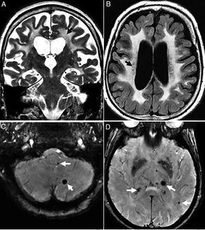 Seventy-seven (77) year old patient with vascular dementia. (A and B) Severe diffuse damage due to confluent hyperintense lesions of subcortical white matter and periventricular in A (coronal FSE-T2 sequence) and B (axial T2 FLAIR sequence). (C and D) Axial slices on the gradient echo sequence showing multiple microhemorrhagic foci in the cerebellum, encephalic trunk (C) and basal ganglia (D).