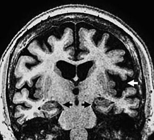 Seventy (70) year old patient with frontotemporal dementia in its aphasic variant. Coronal T1 3D sequence showing left asymmetric perisylvian atrophy (white arrow) with normal hippocampi and structures of the medial temporal lobe (black arrows).