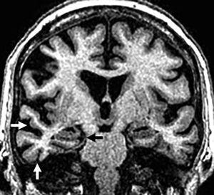 Cognitive impairment in a seventy-two (72) year old male with clinical manifestations of frontotemporal dementia in its semantic variant. Coronal T1 3D sequence showing basal temporal atrophy and predominant right lateral asymmetry (white arrows) with normal hippocampi (black arrow).