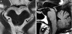 Progressive supranuclear palsy. (A) Axial FSE-T2 image showing midbrain atrophy. The concavity of the lateral margin of the midbrain shows the “Mickey mouse” or“morning glory” sign due to the similarity with such flower. (B) Saggital T1 FLAIR image showing the penguin sign due to a reduced correlation between the atrophied midbrain and the normal pons on the saggital plane. This same sequence shows the hummingbird sign due to roof atrophy (superior quadrigeminal tubercles) and the midbrain tegmentum lossing its usual convex appearance and acquiring a concave morphology with relative preservation of the protuberance and the cerebellum. These structures would relate to the head (midbrain), the body (protuberance) and the hummingbird wings (cerebellum).