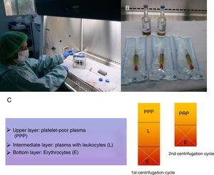(A) After the second spin cycle, the platelet-rich plasma (PRP) is obtained under sterile conditions. (B) Then it is introduced into 2 syringes for later administration and the PRP is ready for injection in sterile bags. (C) Scheme showing how to obtain the PRP from platelet-poor plasma (PPP) after 2 spin cycles.