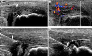 Ultrasound scan showing Achilles tendinopathy (arrow en A) with neovascularity (B). Given the persistent symptomatology with conservative therapy, intratendinous platelet-rich plasma was infiltrated in the area of greater fiber heterogeneity (arrows in C and D).
