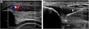 (A) Color Doppler ultrasound scan with signs of patellar tendinopathy with neovascularity. (B) Injection of platelet-rich plasm underneath the deepest fibers of the patellar tendon after pinpricking the tendon (arrow).