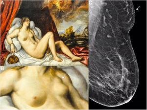 (A) Danae (1554). Anonymous. Oil on canvas in the Art Institute of Chicago. (B) Enlargement of the left axilla of the model portraying Danae; the tumour is marked with a white arrow. (C) Left mediolateral oblique view showing ACR B glandular tissue, radiologically normal axillary and intramammary lymph nodes and accessory breast tissue in left axilla (white arrow) of a radiological density similar to breast tissue.