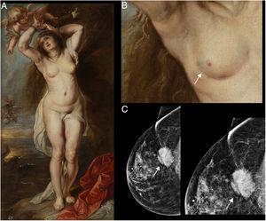 (A) Andromeda, by Peter Paul Rubens (1634), oil on canvas, on display in the Víctor Balaguer Museum & Library. (B) Enlarged view of the right breast in the painting, where retraction of the skin (white arrow) can be seen in the lower outer quadrant. (C) Mammography. Craniocaudal view, ACR B glandular pattern in the outer quadrant, posterior plane, showing a dense, irregular spiculated nodule retracting the pectoral muscle and skin (white arrow), and enlarged view of the nodular lesion marked with a white arrow.