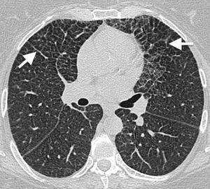 50-Year-old asymptomatic female with history of bilateral adrenal masses and splenomegaly. High resolution axial computed tomography (CT) image of the lung showing extensive cross-linking predominantly in anterior fields, with thickening of interlobular septa and intralobular interstitium (arrows). This is a classic manifestation of lung involvement in Erdheim–Chester disease.