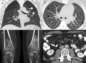 41-Year-old male former smoker with Erdheim–Chester disease. Computed tomography (CT) coronal reconstruction (a) and axial image with maximum intensity projection (MIP) (b). Cysts (arrows) and multiple centrilobular nodules (arrowheads) in both upper lobes, together with centriacinar emphysema. Coronal CT reconstruction of knees (c) showing symmetric bilateral sclerosis in the diaphysis and metaphysis of both femurs. Axial image of abdominal CT (d) in which concentric thickening of the wall of the abdominal aorta can be seen (arrow). Biopsy of a mandibular lesion (not illustrated) confirmed the diagnosis of Erdheim–Chester disease.