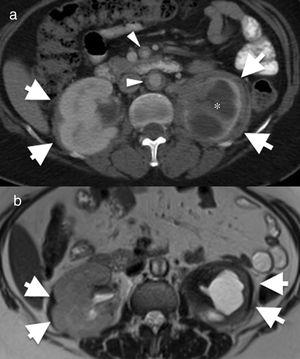 55-Year-old female with Erdheim–Chester disease. She initially presented with lower left quadrant abdominal pain and nausea. Axial computed tomography (CT) image of the abdomen (a) showing bilateral perirenal infiltration by soft tissue (arrows). There is significant atrophy of the left kidney and severe hydronephrosis (asterisk). There is also mural thickening in the abdominal aorta and superior mesenteric artery (arrowheads). (b) Axial magnetic resonance imaging (MRI) T2-weighted spin echo showing the low signal intensity of the perirenal soft tissue (arrows) and of the periaortic infiltrate (arrowhead). The differential diagnosis with this finding includes Erdheim–Chester disease, retroperitoneal fibrosis, sarcoidosis and amyloidosis. The biopsy result confirmed Erdheim–Chester disease. This patient had no disease-related lung involvement.