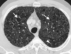 57-Year-old male smoker with progressive dyspnoea. Computed tomography (axial slice) showing confluent cysts of variable shape (arrows) and centrilobular nodules (arrowhead). These findings are typical of Langerhans cell histiocytosis.