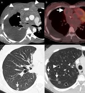 29-Year-old male non-smoker with Hodgkin's lymphoma. Axial image of chest computed tomography (CT), with contrast, in the initial diagnostic study (a) showing a solid mass (arrowheads) with involvement of multiple mediastinal compartments and infiltration in the anterior chest wall (arrows). (b) Axial image of positron emission tomography–CT, 12 months after the start of treatment, showing remission of the disease with the presence of a residual mass (arrow) with no abnormal metabolic activity. The infiltrative component in the anterior chest wall has been resolved. The CT image with lung window (c) shows one of the multiple cavitated lung nodules (arrow) present in the lung parenchyma. The possibility of opportunistic infection and lung metastases were considered in the light of this finding. In axial images of chest CT 2 months later (d), new multiple solid (arrows) and cavitated (arrowhead) lung nodules were detected bilaterally. The histology result ruled out metastatic disease and confirmed pulmonary Langerhans cell histiocytosis.