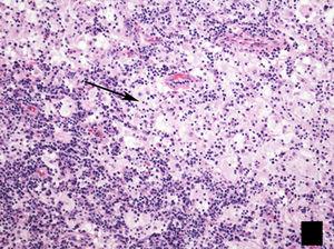 Histological image of lymph node biopsy, stained with haematoxylin–eosin (H–E 100×), showing the typical lesion present in Rosai–Dorfman disease, with a biphasic appearance composed predominantly of lymphocytes (dark areas) and histiocytes (light areas), showing emperipolesis (arrow).