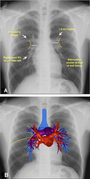 The hilum of the lung: Two classical radiological signs to decipher it ...