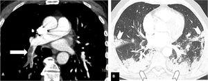 Pulmonary thromboembolism in a medial location in a patient with moderate parenchymal involvement by COVID-19. Chest CT angiography. A) Filling defect in the right lower lobar artery (white arrow). B) Parenchymal involvement with peripheral consolidations in the posterior region of both lower lobes, the medial lobe and the lingula (arrow heads), involving 30-60% of the lung parenchyma.