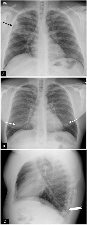 Atypical findings in COVID-19 pneumonia. (A) Lobar pneumonia. A 28-year-old male with signs and symptoms consistent with COVID-19 and positive PCR for SARS-CoV-2. Chest X-ray in posteroanterior (PA) projection. Right upper lobe involvement (arrow). (B and C) Bilateral involvement and pleural effusion. A 17-year-old male with fever and positive PCR for SARS-CoV-2. PA (B) and lateral (C) chest X-ray. Faint bilateral infiltrates in lower fields (arrows) with minimal pleural effusion in the left posterior costodiaphragmatic sinus (arrow tip).
