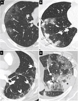 Typical findings in COVID-19 pneumonia on computed tomography (CT). Axial chest CT images with 1-mm slices. (A) Ground-glass opacities with rounded morphology and a peripheral and subpleural distribution (arrows). (B) Consolidations with a peripheral and subpleural predominance (arrows). (C) Reticulation with a peripheral and subpleural location (arrow tips). (D) Peripheral ground-glass opacities with overlapping interlobular and intralobular septal thickening in relation to a crazy-paving pattern (arrow). Peripheral consolidation (asterisk) is also seen.