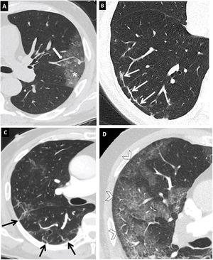 Typical findings in COVID-19 pneumonia on computed tomography (CT). Axial chest CT images with 1-mm slices. (A) Vascular thickening (arrow) associated with an area of ground-glass opacity (asterisk). (B) Subpleural curvilinear line (arrow). (C) Subpleural parenchymal bands (arrows). (D) Hypoattenuating line (arrows) between visceral pleura and ground-glass opacity (arrow tips).