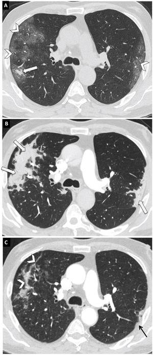 Progression of COVID-19 pneumonia in a 56-year-old woman. Axial chest computed tomography (CT) images with a thickness of 1 mm at the level of the carina. (A) Study 10 days after the onset of symptoms. Peripheral and bilateral ground-glass opacities (arrow tips) and a small consolidation forming in the posterior segment of the right upper lobe (arrow). (B) CT scan 15 days after the first CT scan. Progression of ground-glass opacities to consolidations (arrows). (C) CT scan 32 days after the first CT scan. Partial resorption of consolidations (arrow tips) and focal pleural thickening in the apicoposterior segment of the left upper lobe (black arrow).