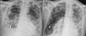 A 54-year-old man with COVID-19 pneumonia who required intubation and intensive care unit admission, one week after the onset of symptoms, due to marked clinical and radiological worsening. A follow-up X-ray one month later (A) showed pneumatoceles at the right lung base (arrows) secondary to COVID-19. B) Four days later, the patient abruptly desaturated with a significant right pneumothorax (asterisk).