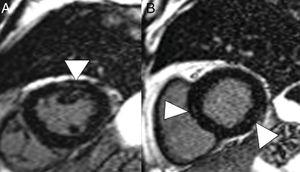 A 59-year-old man with no personal history of note, with mild COVID-19 pneumonia. He presented chest pain and serial troponin elevation, with suspicion of inferior akinesia on echocardiography. Short-axis reconstructions and a late enhancement sequence showed hyperintense linear images in the thickness of the myocardium (arrow tips in A and B) consistent with myocarditis.