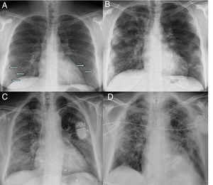 Initial X-ray (A) and X-ray at 12 days (B) in a patient with COVID-19 and moderate disease. The initial X-ray shows subtle peripheral ground-glass opacities in the lower lung fields (arrows). The X-ray at 12 days shows predominantly peripheral multifocal consolidations. Initial X-ray (C) and X-ray at 20 days (D) of another patient with COVID-19 and moderate disease, in which ground-glass opacities initially seen at the base and in the peripheral region of the middle and upper fields progress to a gross alveolar interstitial pattern with a predominance in the peripheral region of the middle and upper fields.