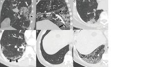 Typical findings in the third and fourth weeks of the disease. A) Consolidation focus with architectural distortion causing retraction of the fissure (white arrow) and the adjacent pleura (black arrow tip). B) Ground-glass and consolidation opacities associated with bronchiectasis (arrow) and pleural thickening of the oblique fissure (arrow tip). C) Subpleural consolidation focus with associated bronchial dilatations. D) Subpleural line parallel to the pleura, associated with architectural distortion (arrow tips). Patient with a previously healthy lung parenchyma (E) having developed an extensive reticular pattern secondary to thickening of the intralobular septa with some associated bronchial dilation (F).