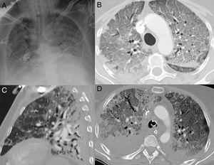 Radiographic pattern of diffuse alveolar damage in patients with COVID-19. A) Complete opacification of both lungs with air bronchogram. B) Extensive cobblestone pattern with small consolidation foci with a posterior predominance in a patient with symptoms for 10 days, requiring intensive care unit admission. C) Sagittal reconstruction where the typical gravitational gradient is identified with consolidations in sloping areas, ground-glass opacities and a cobblestone pattern in intermediate areas, with relatively spared areas in non-sloping areas. D) Axial image with gravitational gradient, consolidations predominantly in dependent areas and an extensive anterior cobblestone pattern. Bilateral pleural effusion, which is much more common in patients with severe disease, is seen.