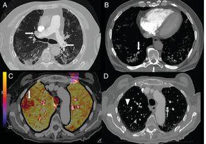 A) A 73-year-old man with bilateral central pulmonary embolism (arrows). B) A 77-year-old man with COVID-19 and segmental pulmonary embolism related to consolidation in the right lower lobe, suggesting vascular thrombosis (arrow). C and D) A 89-year-old woman with COVID-19 and D-dimer elevation. A CT angiogram with iodine subtraction mapping showed a peripheral perfusion defect (arrow) correlated with a subtle segmental and subsegmental filling defect in the right upper lobe (arrow tip).