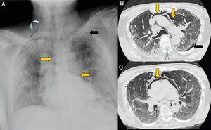 A 67-year-old man with extensive bilateral COVID-19 involvement and severe respiratory failure. Notable on the portable chest X-ray (A) are right supraclavicular subcutaneous emphysema (curved arrow), pneumomediastinum (orange arrows) and left apical pneumothorax (black arrow). Images B and C from chest CT confirm all findings and also show pneumorrhachis (blue arrow tip).
