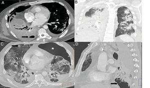 A and B) Patient with COVID-19 and moderate disease who presented worsening 10 days after admission, with leukocytosis, increased procalcitonin, complete consolidation of the right lower lobe, partial opacification of the right upper and middle lobe, and hydropneumothorax (arrow) in a context of bacterial superinfection. C) Patient with COVID-19 and severe disease, diagnosed with invasive pulmonary aspergillosis. CT showed a pulmonary nodule in the right upper lobe with an area of central cavitation (arrow) and the presence of a left pneumothorax (star). D) The same patient presented extensive cavitated lesions (arrow) at the right lung base.
