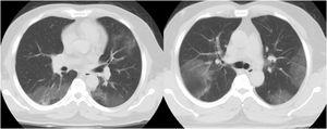 Two axial non contrast lung window chest CT scan demonstrate multifocal patchy GGO on both lungs field in a patient with COVID-19 pneumonia.