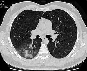 Axial non-contrast lung window chest CT scan shows mixed GGO and consolidative opacity on right lung field in a patient with COVID-19 pneumonia.
