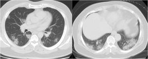 Two axial non-contrast lung window chest CT scan demonstrate multifocal patchy consolidative opacities on both lungs field in a patient with COVID-19 pneumonia.