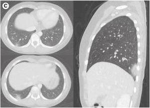 Chest CT imaging in a 10 y/o female on the fourth day following symptom onset demonstrating patchy nodular consolidations with peripheral ground glass opacities in axial and sagittal views of the right lung. Reprinted with permission from Ref.27, which is open access and published under the Creative Commons License.