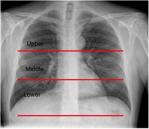 Lung division on posteroanterior chest X-ray. This image illustrates the delimitations of the upper, middle and lower fields required to apply the ERVI scale. The upper field is above a horizontal line that passes through the carina, the lower field is below a horizontal line that passes through the lower pole of the right hilum, and the middle field is the space between the two lines.