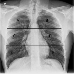 Chest X-ray with lung division into six fields used in our study to assess distribution of X-ray findings. The upper horizontal line is at the lower edge of the aortic arch and the lower horizontal line is at the height of the inferior pulmonary veins. A and B) Upper fields. C and D) Middle fields. E and F) Lower fields.