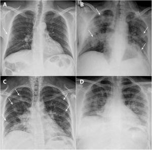 A and B) A 49-year-old man, a former smoker who quit smoking five years earlier, had a history of hypertension, dyslipidaemia, hypertensive cardiomyopathy, hyperuricaemia, kidney transplantation and total thyroidectomy due to papillary thyroid carcinoma. He came in with fever, dry cough and muscle pain for the past four days. Laboratory data: leukocytes 7100/μl, lymphocytes 600/μl (lymphocyte-to-leukocyte ratio 7.7%), platelets 140,000/μl, CRP 1.63mg/dl, D-dimer 754ng/mL and LDH 471 U/l. A posteroanterior chest X-ray taken on 16 March 2020 showed a peripheral ground-glass opacity in the right middle field (X-ray severity score=1) (arrow). The patient was admitted, and a chest X-ray taken on 24 March 2020 showed clear radiological worsening with more extensive bilateral lung consolidations (arrows) associated with an increased need for oxygen therapy. C and D) A 33-year-old woman from Guatemala with no personal history of note visited the accident and emergency department with a referral from her primary care doctor due to cough and fever for the past nine days. Blood testing: leukocytes 5100/μl, lymphocytes 1400/μl (lymphocyte-to-leukocyte ratio 27.9%), platelets 224,000/μl, CRP 8.44mg/dl, D-dimer 500ng/mL and LDH 666 U/l. A posteroanterior chest X-ray taken on 17 March 2020 identified patchy bilateral lung consolidations predominantly in the lower lobes (score=5) (arrows). The patient was admitted, and two days later, she showed worsening of signs and symptoms as well as laboratory values; a chest X-ray taken on 23 March showed radiological worsening, with confluence of her prior consolidations.