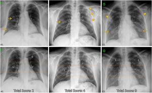 Chest X-ray features. Up: examples of distribution, density of opacities and extent score. Down (the same CXR): Division of lung fields. Upper fields (suprahillar area) limited by the line that passes under the aortic arch; medium fields (hilar area) and inferior fields (infrahilar area) separated by the line that divides the rest of the lungs into two halves (frequently this line crosses the bifurcation of the right inferior lobar artery). A1: Unilateral central and peripheral low-density opacities (arrow), without predominance. A2: Medium and lower right fields involved ≤ 50%; ExtScoreCXR = 2. B1: Central right low-density opacity (arrow) and peripheral left consolidation (larger arrows). Peripheral predominance. B2: Medium right and left fields with ≤50% of involvement and upper left field with >50% of involvement; ExtScoreCXR = 4. C1: Bilateral low-density opacities (arrows) and consolidations (larger arrows) without predominance. C2: Upper fields and lower left field with ≤50%, medium fields and right lower right field with >50% of involvement; ExtScoreCXR = 9.