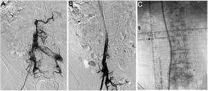 Dysfunctional right femoral haemodialysis catheter in phase 2. An angiogram revealed severe inferior vena cava stenosis with drainage to collateral circulation (A). Angioplasty and endoprosthesis repositioning were then performed in a second procedure (B), as was placement of a tunnelled femoral catheter through the endoprosthesis to the right atrium, all with satisfactory outcomes (C).