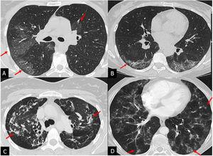 Idiopathic pulmonary fibrosis | Radiología (English Edition)