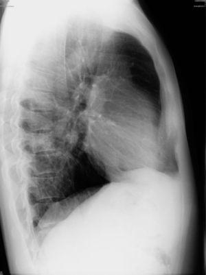 Rentgenogram klatki piersiowej (ujęcie boczne) wykazujący hipotransparentność dolnej części płuca lewego.