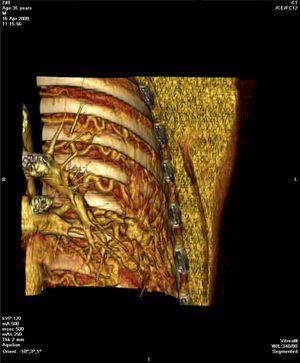 Koronalna rekonstrukcja TK 3D wykazująca poszerzenie i krętość tętnic międzyżebrowych oraz poszerzenie gałęzi segmentalnej lewej tętnicy płucnej związane z obwodową plątaniną tętniczych naczyń krwionośnych w lewym dolnym płucu.